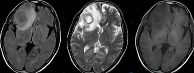 Абсцесс головного мозга на МРТ