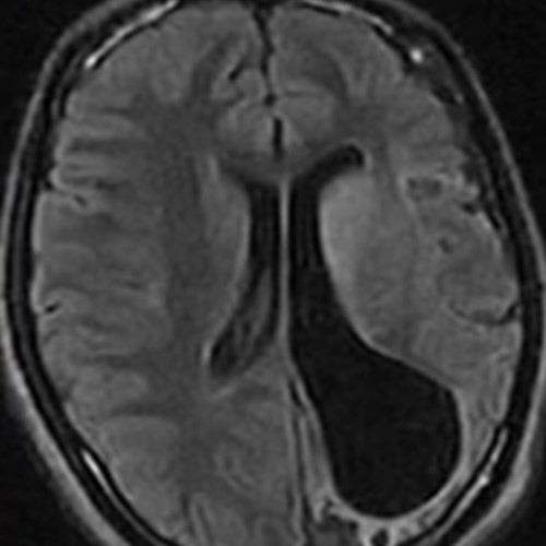 Энцефалит на МРТ головного мозга