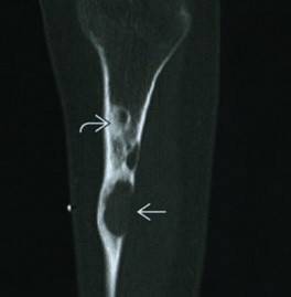 КТ-снимок при фиброме кости