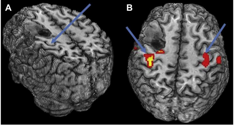 Объемное МР-изображение при опухоли головного мозга