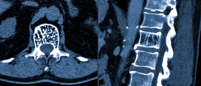 Кавернозная гемангиома на снимках КТ грудного отдела позвоночника
