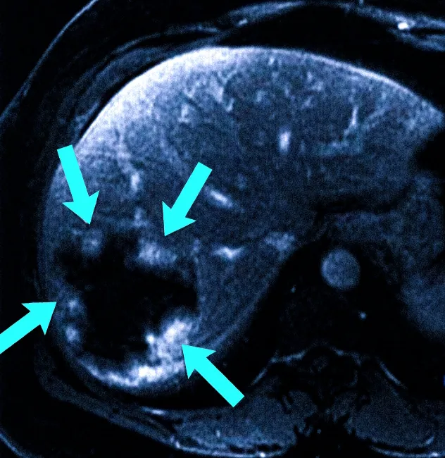 Гемангиома печени на МРТ
