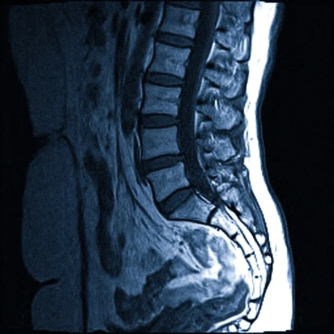 МРТ поясничного отдела позвоночного столба