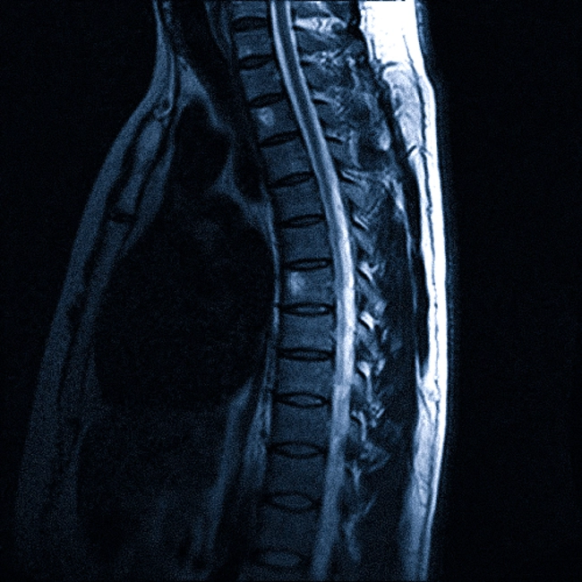 Гемангиома позвоночника на МРТ