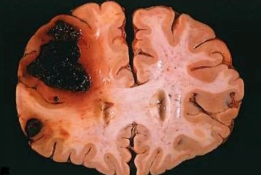  Макропрепарат мозга после кровоизлияния в паренхиму