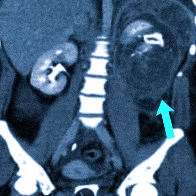 Гематома почки на КТ