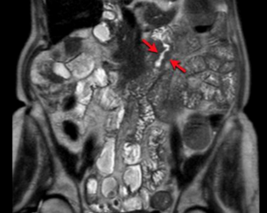 Карцинома 12-перстной кишки на МР-скане