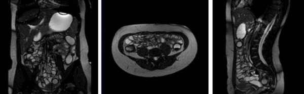  Трехплоскостная визуализация кишечника на магнитно-резонансной томографии