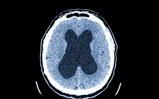 Гидроцефалия головного мозга на КТ