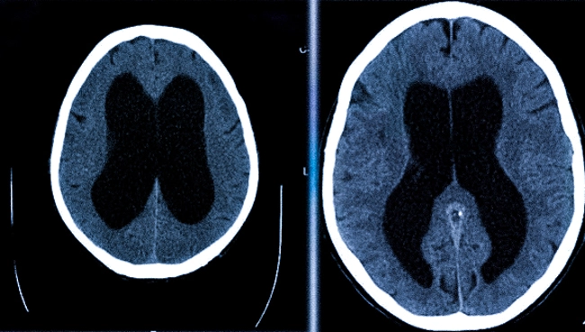 КТ при гидроцефалии