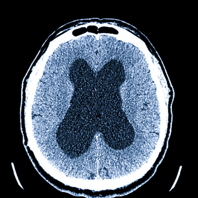 Гидроцефалия головного мозга на КТ