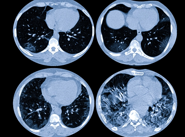 Последствия коронавирусной инфекции на КТ легких