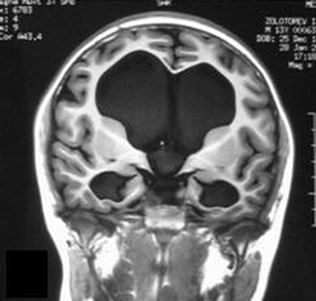 Водянка головного мозга на МРТ