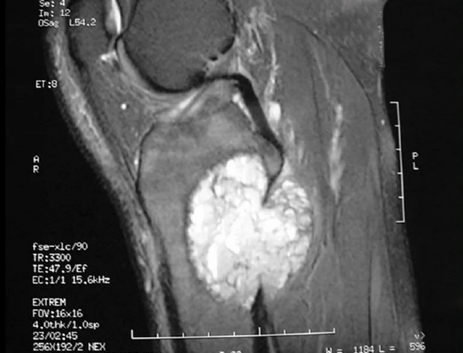  Гигантоклеточная опухоль на снимке МРТ
