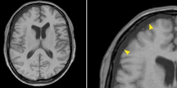 Гигрома над областью лобной доли справа на МРТ-снимке (указана стрелками)