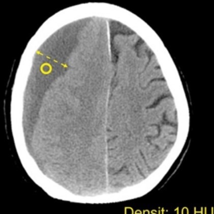 Гигрома головного мозга на КТ