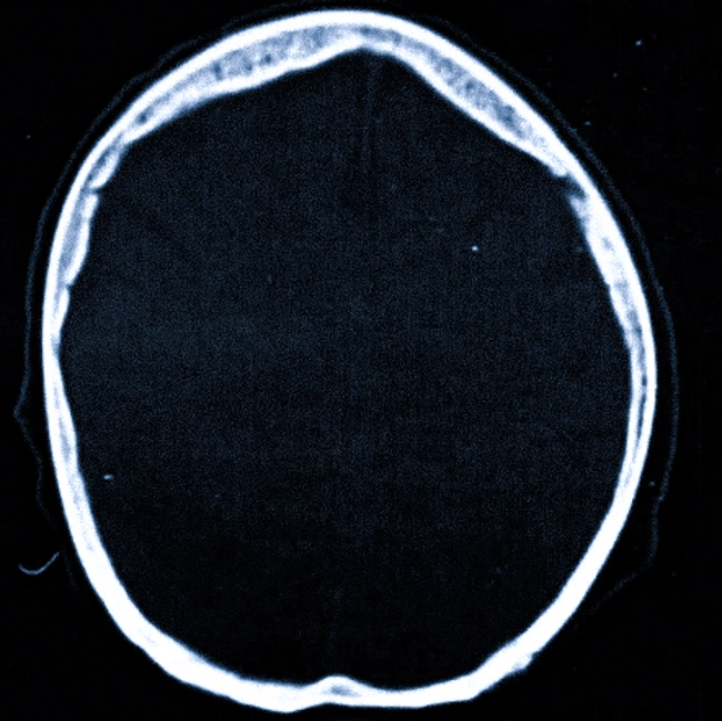 Гиперостоз лобной кости на КТ