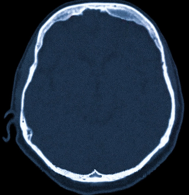 Гиперостоз лобной кости на КТ