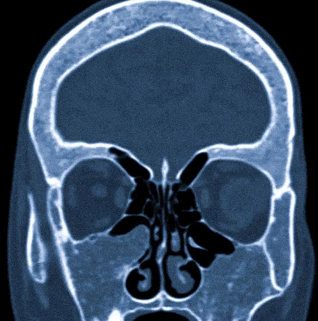 Гиперостоз лобной кости на КТ