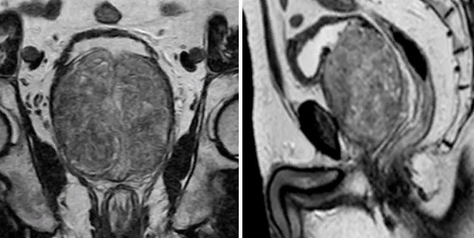 МРТ: картина доброкачественной гиперплазии простаты