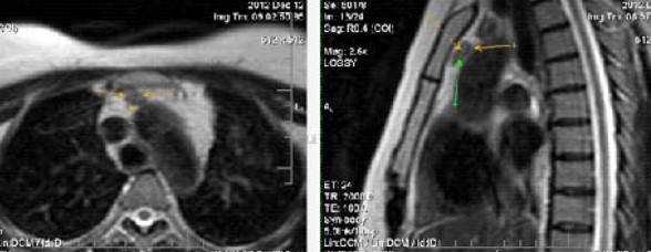 Остаточная ткань вилочковой железы на МР-снимке