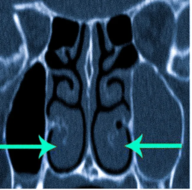 Гипертрофия нижних носовых раковин на КТ