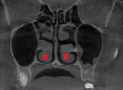 КТ-изображение получено у пациента с хроническим гиперпластическим ринитом