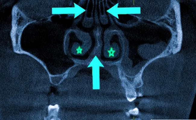 На снимке звездочками отмечена гипертрофия нижних носовых раковин