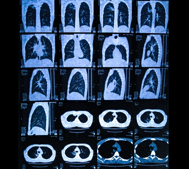Пленка с КТ-изображениями легких