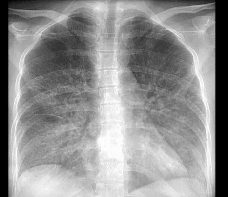 Рентгенография грудной клетки при пневмонии на фоне порока сердца