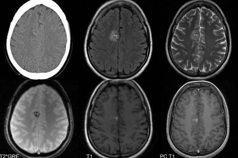Микроангиопатия головного мозга, очаговые изменения на МРТ (аксиальная проекция)