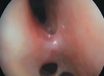 Картина риноскопии: в одной из ноздрей образовалась синехия (перегородка) на фоне гранулематозного воспаления