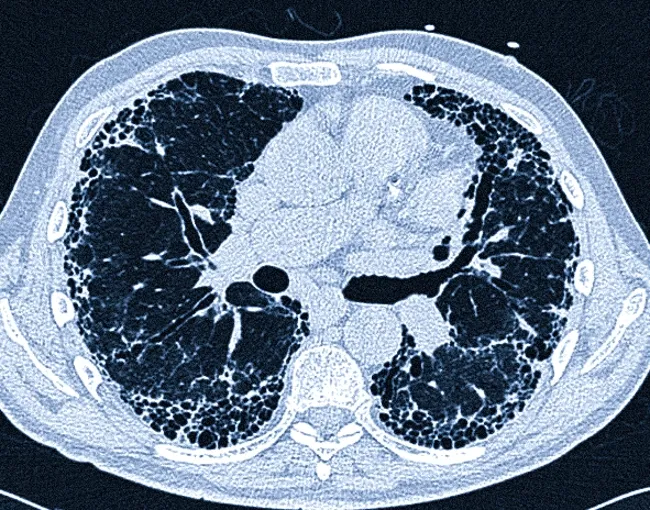  Фиброзирующий альвеолит на КТ