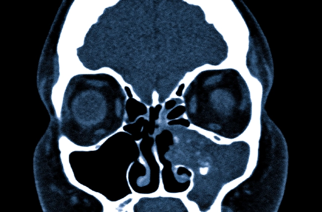 Мицетома на КТ гайморовой пазухи