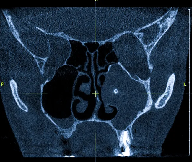 Грибковое тело в гайморовой пазухе на КТ