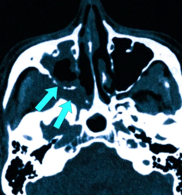 На КТ видно поражение грибком верхнечелюстной пазухи справа