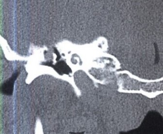 На КТ-изображении представлено разрушение и смещение слуховых косточек
