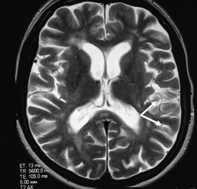 Очаги глиоза (показаны стрелками) на снимке МРТ головного мозга в аксиальной проекции