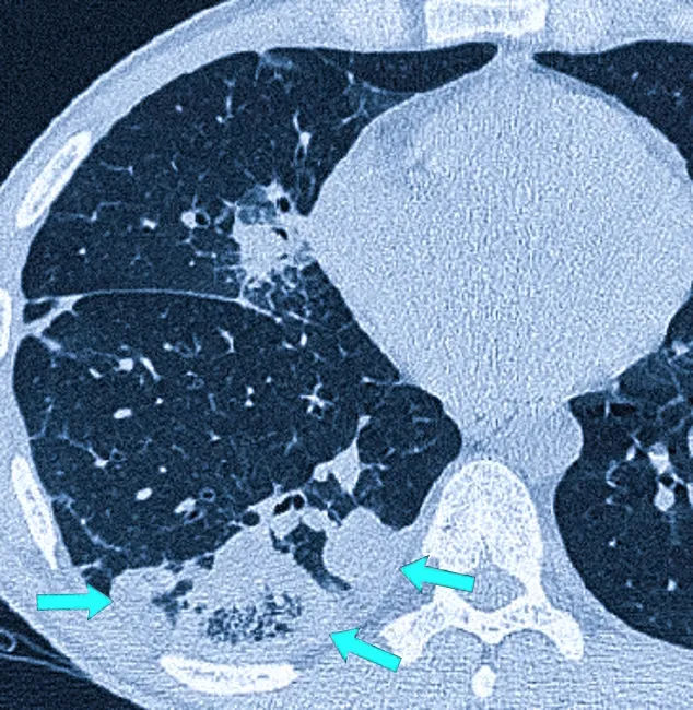 Стрелки указывают на воспаление легочной ткани в участке