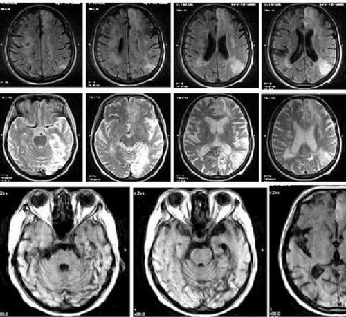 Серия снимков МРТ при подозрении на инсульт