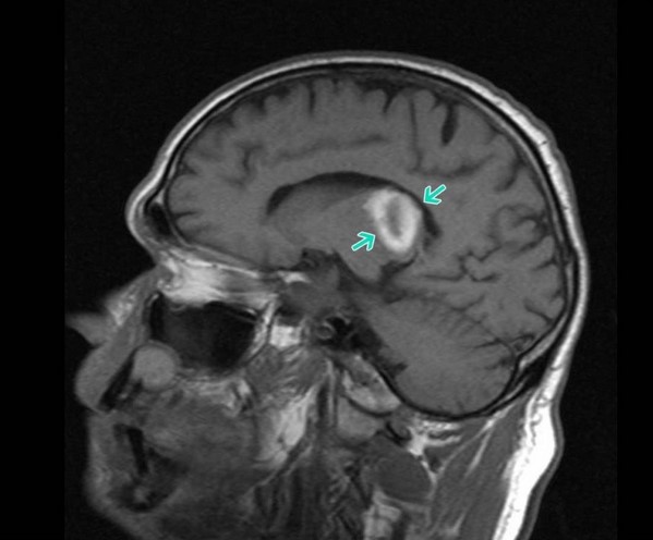 Очаг ишемии и некроза головного мозга (показан стрелками) на МРТ