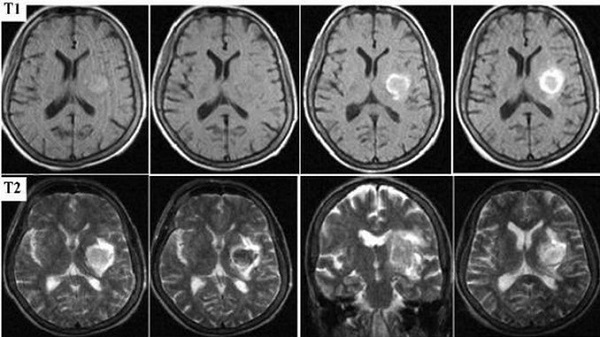 Очаг ишемии и некроза головного мозга (показан стрелками) на МРТ