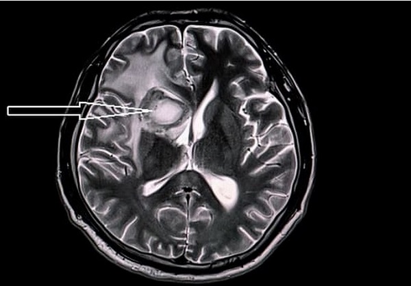 Инсульт на МРТ головного мозга