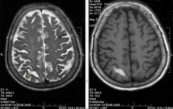 Инфаркт головного мозга на МРТ