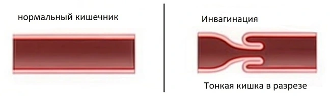 Инвагинация тонкой кишки на КТ