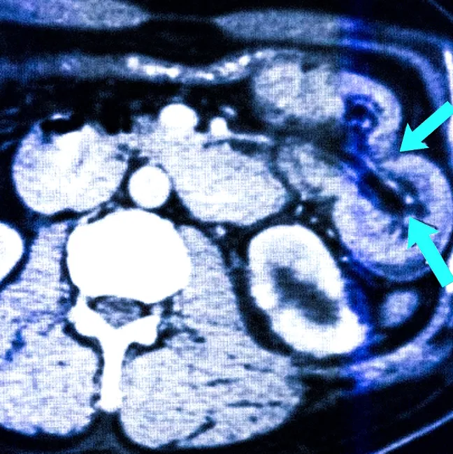 Инвагинация тонкой кишки на КТ