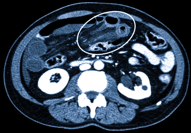 Инвагинация тонкой кишки на КТ