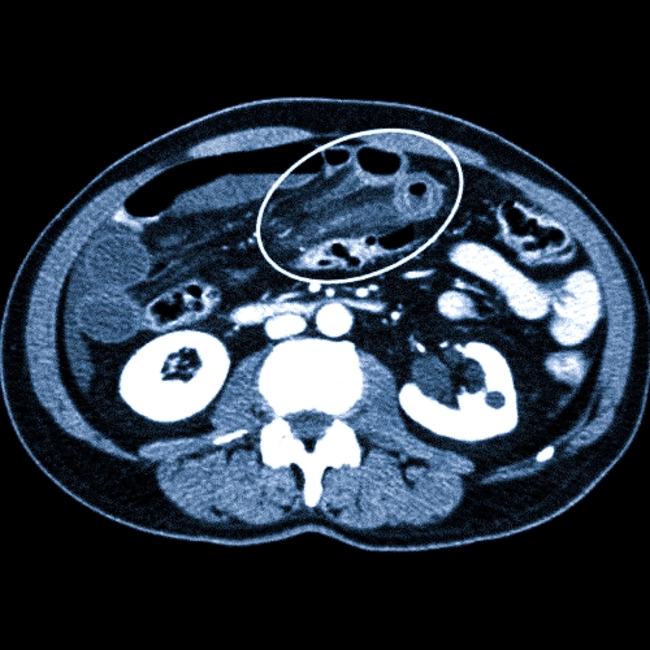 Инвагинация тонкой кишки на КТ