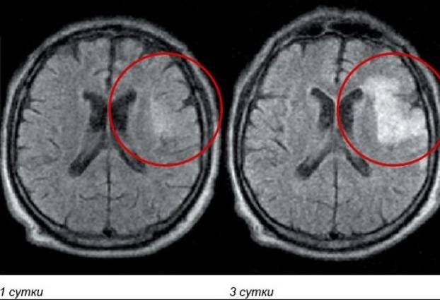 Красным выделен участок ишемии мозга в динамике на МРТ
