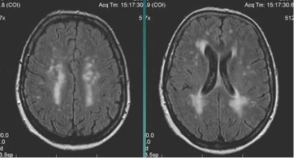 МР-снимок показывает дистрофические изменения белого вещества вокруг желудочков мозга, характерные для хронической ишемии (лейкоареоз)